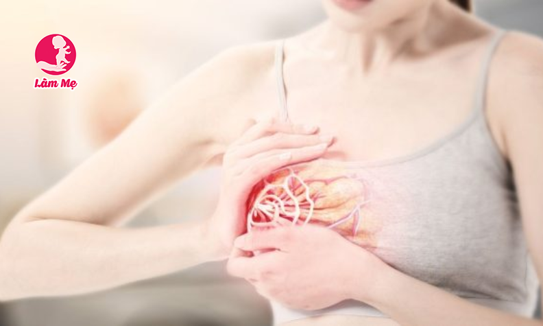 Tắc tia sữa là gì? Cách chữa tắc tia sữa hiệu quả